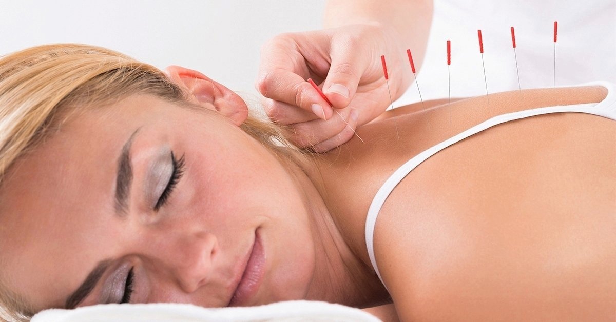 Test akupunktúrás kezelés